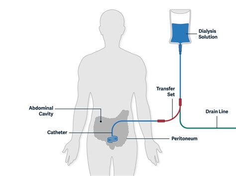 Treatment Options | Pure Life Renal Dialysis Centers