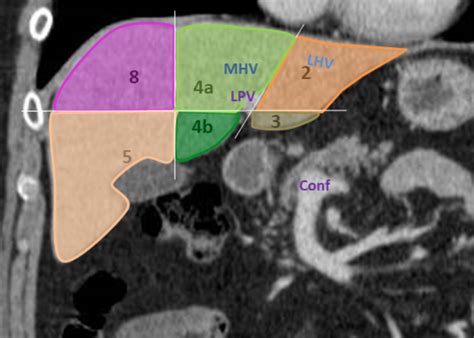 Liver Segments Ct Scan