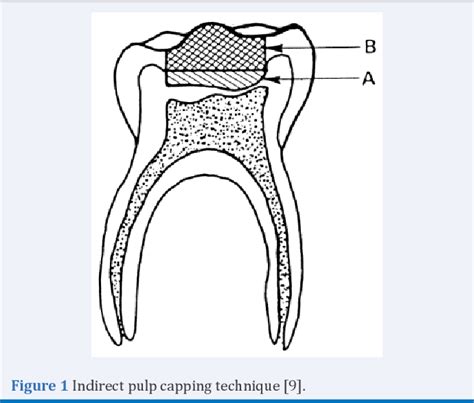 Figure 1 from Indirect and Direct Pulp Capping: Reactionary vs. Reparative Dentins | Semantic ...