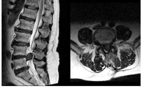 MRI Herniated Disc In Neck