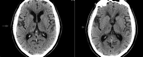 Radiology MRI: Thalamic Infarct