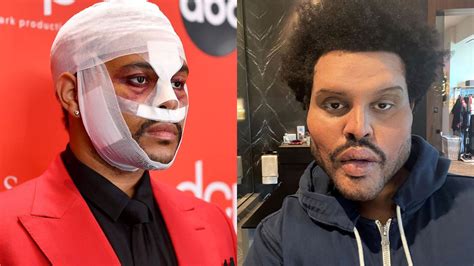 The Weeknd Keeps Freaking Us Out With His Botched Plastic Surgery Face ...