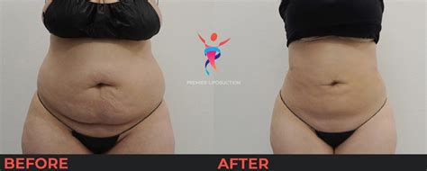 Before and After Liposuction Gallery | See the Results!