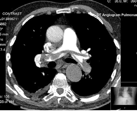 Saddle Pulmonary Embolism - CTA Chest - radRounds Radiology Network