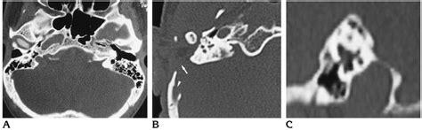 Vessel canal aberrations. A, Axial CT scan at the level of the foramen ...