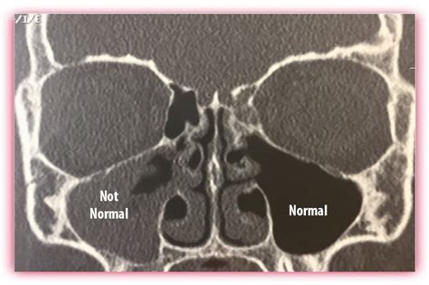 Several Sinus Surgery Types That Make a BIG impact - Dr Momma Says