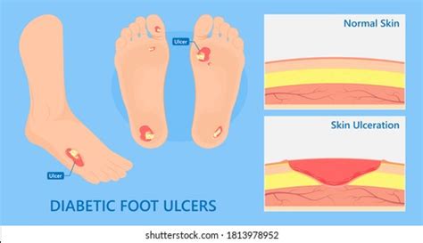 Eschar Wound - Wcw Debriding Eschar From A Leg Ulcer Youtube - Slough ...