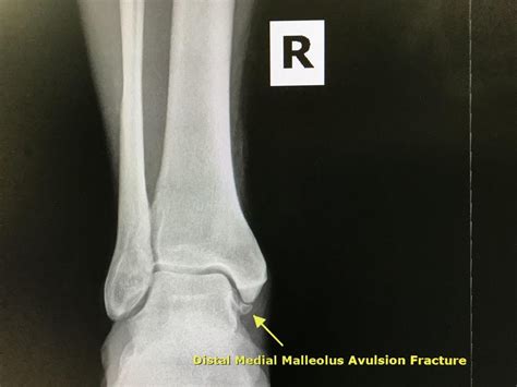 Fibular Avulsion Fracture