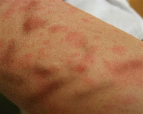 Itchy Skin Rash - Pictures, Causes, Symptoms, Treatment - HubPages