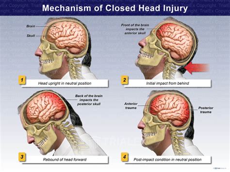 Mechanism of Closed Head Injury - Trial Exhibits Inc.