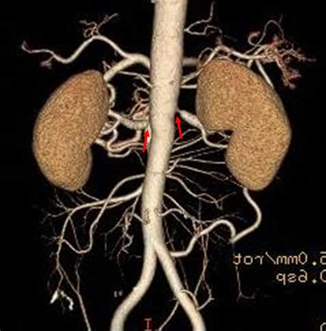 Renal artery stenosis