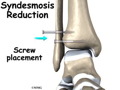 High Ankle Sprain - Ankle Syndesmosis - eOrthopod.com