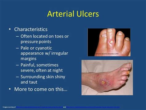 Arterial ulcer_explained (note:pale or cyanotic appearance) Nursing Cheat, Medical Laboratory ...