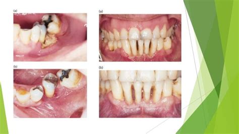 Necrotizing periodontal disease