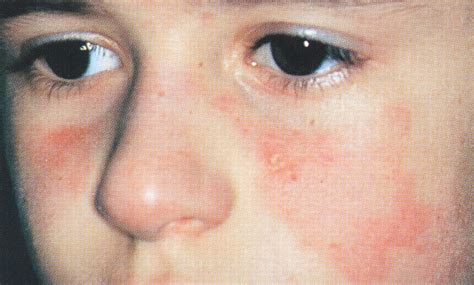 Malar Rash in a Child—Quiz Case | Dermatology | JAMA Dermatology | The ...