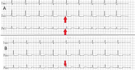 ECG Rhythms: Wandering Rhythm