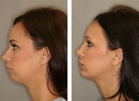 Pin by Lynette Foster on Get Rid Of A Double Chin With Face Exercises | Facial plastic surgery ...