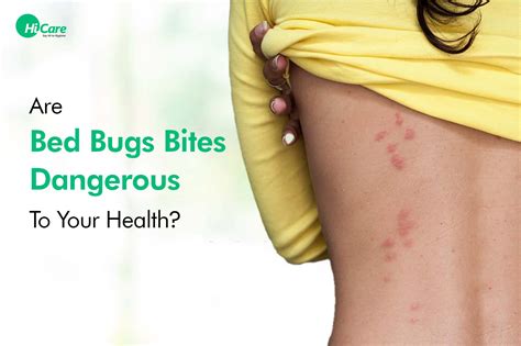 Bed Bugs Bite: Everything about Bed Bugs Bite Treatment | HiCare