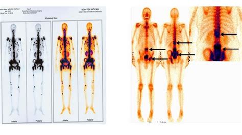 3-phase bone scintigraphy technique | Vinmec