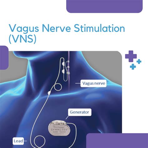 Vagus Nerve Stimulation (VNS) - LGS Foundation