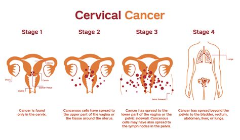 Treatment Of Cervical Cancer