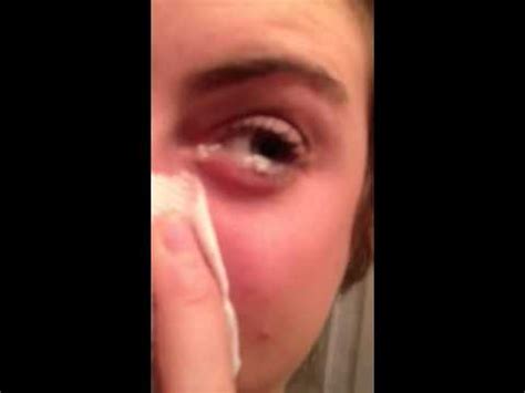 Mucus coming out of eye!!! - YouTube