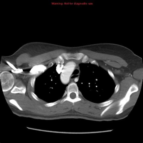 Right aortic arch with aberrant left subclavian artery | Radiology Case | Radiopaedia.org ...