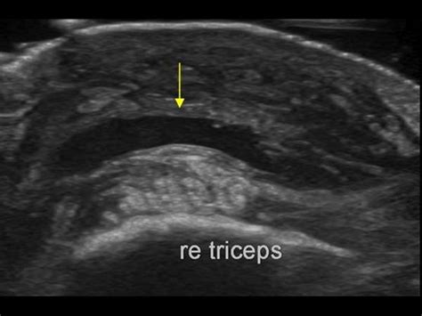 Musculoskeletal Joints and Tendons | 6.2 Elbow : Case 6.2.5 Olecranon bursa and triceps tendon ...