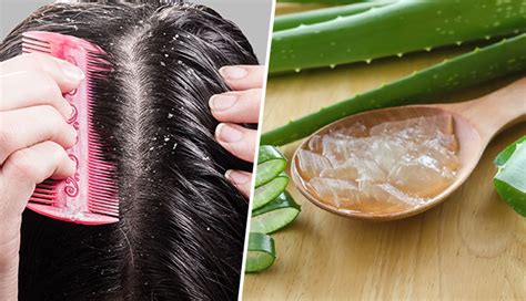 8 Homemade Aloe Vera Gel Hair Masks For Common Dandruff Problems - lifeberrys.com