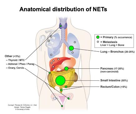 What are neuroendocrine tumours (NETs)? - RareCan