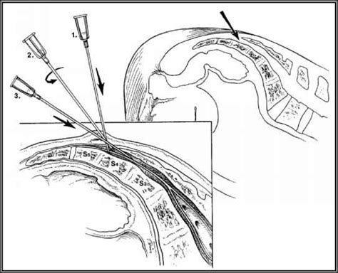 Caudal Canal Pictures - Regional Anesthesia - Mitch Medical