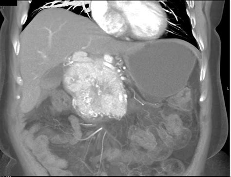 Neuroendocrine Tumor Pancreas - Pancreas Case Studies - CTisus CT Scanning