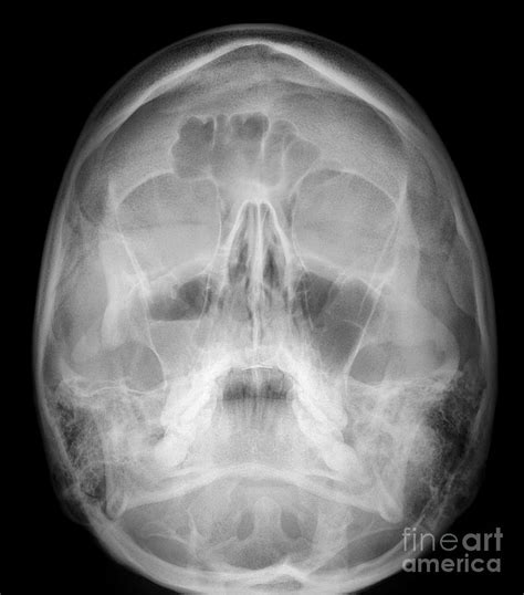 Facial Fractures, X-ray Photograph by Science Photo Library