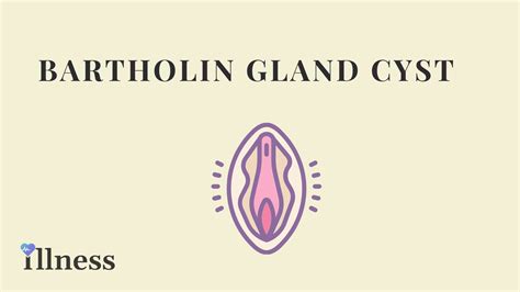 Bartholin Gland Cyst: Overview, Causes, Symptoms, Treatment | Illness.com