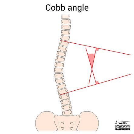 Cobb angle (illustration) | Radiology Case | Radiopaedia.org