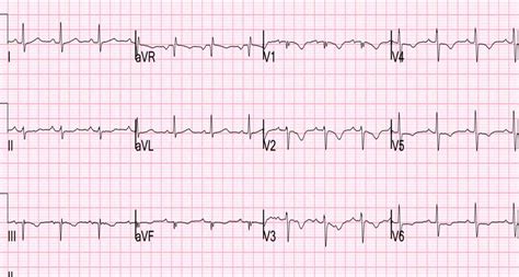 Pulmonary Embolism On The Electrocardiogram | The Best Porn Website