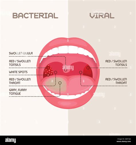 infección bacteriana y viral de la garganta, inflamación de las amígdalas Imagen Vector de stock ...