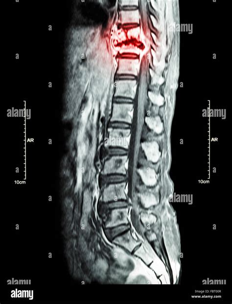 Spine metastasis ( cancer spread to thoracic spine ) ( MRI of thoracic and lumbar spine : show ...