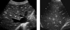 Strawberry Radiological sign Strawberry gallbladder Strawberry gallbladder refers to the surface ...