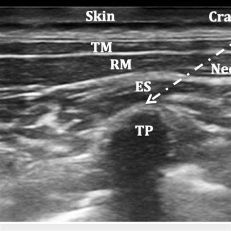 (PDF) Defining the Indications and Levels of Erector Spinae Plane Block ...