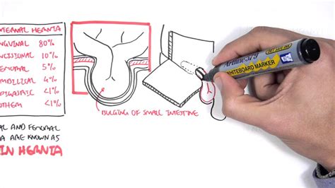 Hiatus Hernia بالعربي – ايميجز