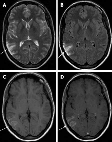 Tomba Dittatura capsula cortical laminar necrosis Grande universo Gelido Costa