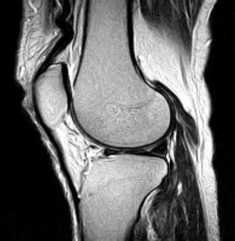 Mri Images Of Problem Knee