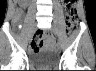 Retrocecal appendicitis | Image | Radiopaedia.org