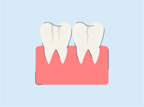 What are Craze Lines? Causes and Treatment