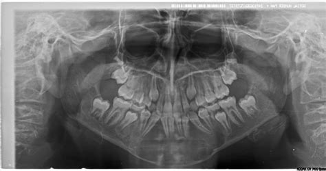 Dr. Gabbaypour, DDS, MD: Central Giant-Cell Granuloma