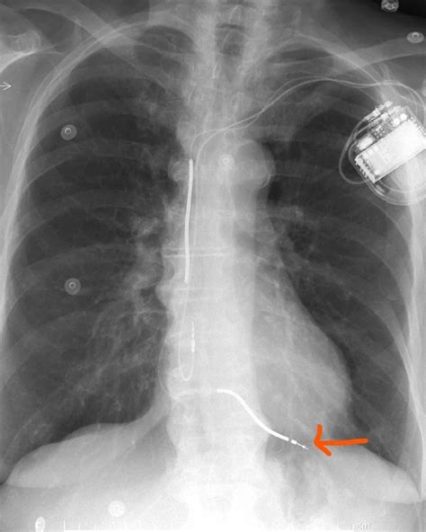 Unusual Delayed Complication of Pacemaker Leads | Cureus