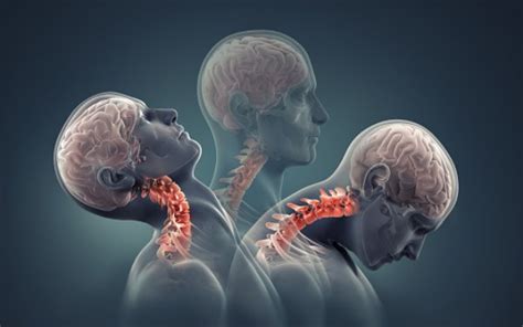 Reversal Of Cervical Lordosis Treatment - Quotes Update Viral