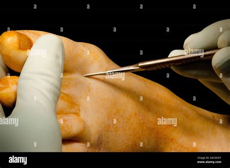 Foot surgery. Surgeon making an incision in the foot of a 50-year-old female patient with severe ...