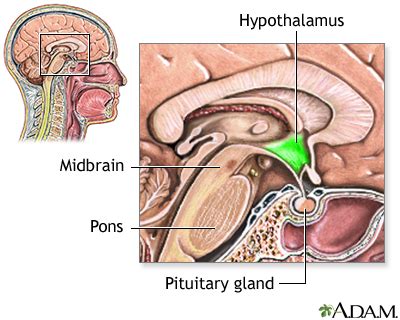 Hypothalamic dysfunction Information | Mount Sinai - New York